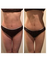 ファロンビューティー(fallon beauty)/痩身ビフォーアフター