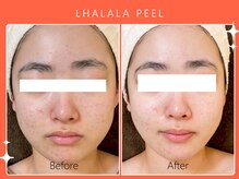 ハノハノ 八代店(HANO HANO)/韓国肌管理ララピール☆