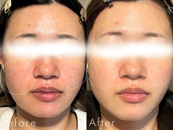 セルフミー 恵比寿(SELF Me...)/ハーブピーリング/ニキビケア