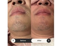 インフィニティ(INFINITY)/ヒゲ脱毛