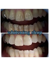 ホワイトニングショップ 池田店/【BEFORE/AFTER】