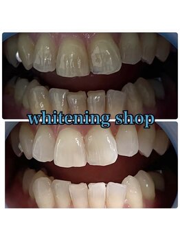 ホワイトニングショップ 池田店/【BEFORE/AFTER】