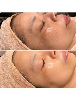 トータルエステティック ジョワイユ(JOYEUX)/しみクスミ毛穴改善