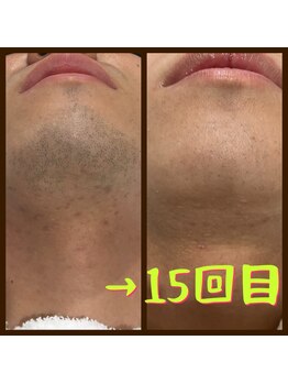 リアンジュ/ヒゲ脱毛の経過