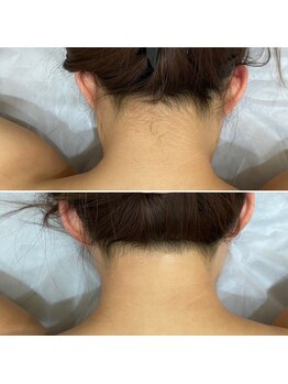 インベスト(INVEST)/うなじ脱毛