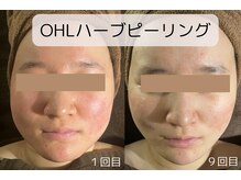 カヨン 新所沢店(KAYON)の雰囲気（シミ肌荒れケアに。肌の質を整えるハーブピーリング[小顔/毛穴]）