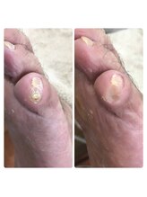 厚木 海老名 巻き爪矯正センター/事例【ドイツ式フットケア】