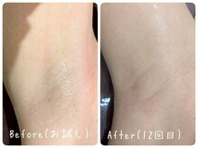 ホッコリ 段原店(HOKKORI)/ワキ脱毛