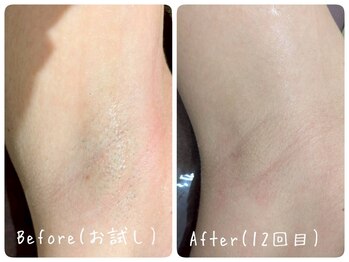 ホッコリ 段原店(HOKKORI)/ワキ脱毛