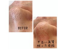 メンズプシュケ(men's PSYCHE)/毛穴洗浄