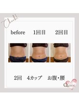 クイーン(QUEEN)/脂肪冷却　4カップ