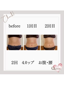 クイーン(QUEEN)/脂肪冷却 4カップ