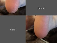 テリー(Terry)/韓国式足裏角質ケアbefore after