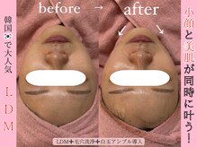 エンクリニカルラボ 京都駅前店(E&N CLINICAL LABO)/ダウンタイムなし◯W照射のLDM