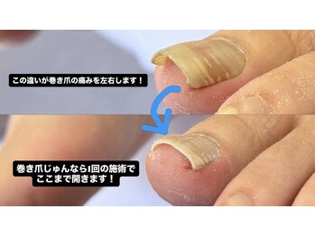 巻き爪じゅん 千葉駅前店/巻き爪は開き方で変わる！