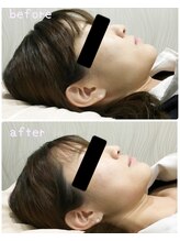 ライト(light)/光フェイシャルビフォーアフター