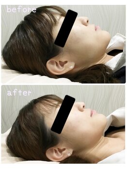 ライト(light)/光フェイシャルビフォーアフター