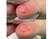 巻き爪補正店 広島紙屋町店の雰囲気(足の小指横の副爪ケア〉〈お痛みほぼなく短時間(20分程)でケア)