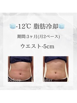 メディカルエステ 東銀座店/-12℃脂肪冷却 before/after