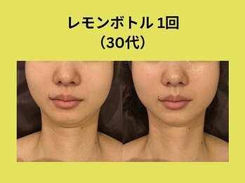 アユアラングレース/レモンボトル1回