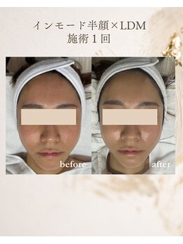 フォルディオ(FORDIO)/インモード半顔×LDM