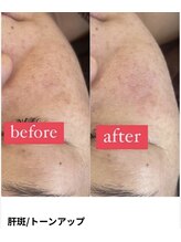 ミラビューティー(Mira Beauty)/くすみケア/透明感アップ