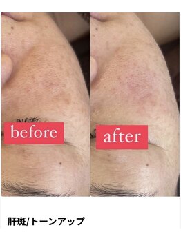 ミラビューティー(Mira Beauty)/くすみケア/透明感アップ