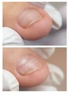 深爪＆陥入爪