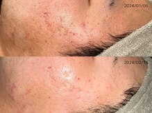 レイル(REIR)/純粋レチノールピール施術3回目