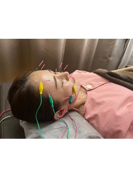 鍼灸施術を受けたい