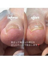 ネイルサロン ユーズ(USE.)/巻き爪ケア/フットケア