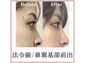 ラプリボヤージュ 藤沢店(Raplit)/ 隆鼻＋輪郭矯正40分10回コース