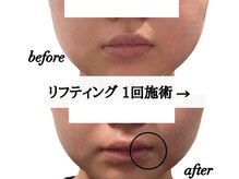 ステラ(Stella)/メニュー【リフティング】