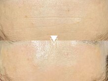 【究極の美肌】しみ・しわケア！憧れのたまご肌・水光肌を手に入れる水光肌フェイシャル9980円【ツヤ肌】