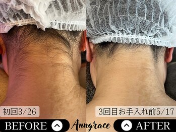 アングレイス(Anngrace)/【顔脱毛うなじ】Before/After