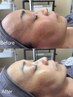 OPEN記念♪【平日限定】毛穴ケア×贅沢高周波サーマトリックス◎くじ引き付き