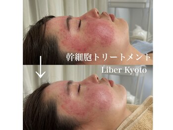 リベルキョウト 京都駅前店(Liber Kyoto)/即美白!レチノール/幹細胞パック