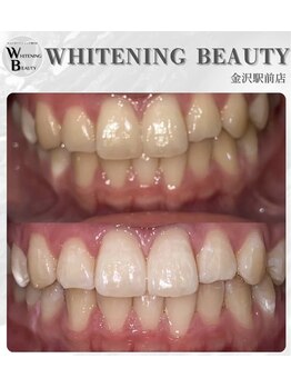 ホワイトニングビューティー 金沢駅前店(WHITENING BEAUTY)/初回でも効果を実感できる!