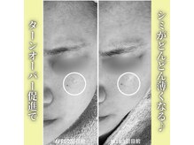 ハニエル(Haniel)/無針水光注入症例