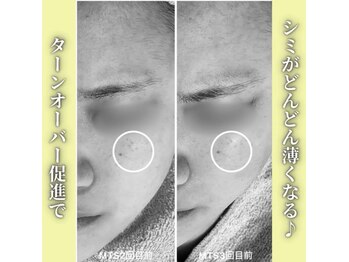 ハニエル(Haniel)/無針水光注入症例