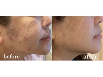 レアビューティー(Le'a beauty)の写真/《なかなか改善しない深いお悩みの肌荒れ、シミ、くすみ、たるみ》にLe'abeautyで肌管理