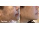 レアビューティー(Le'a beauty)の写真/《なかなか改善しない深いお悩みの肌荒れ、シミ、くすみ、たるみ》にLe'abeautyで肌管理