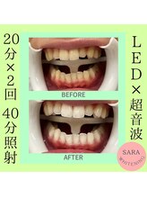 ココティ ホワイトニング(Cocotii)/お客様ビフォーアフター