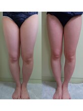 ソフィーム/脚痩身