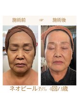 リラクゼーションサロン ラキ(laki)/ネオピール/ピーリング