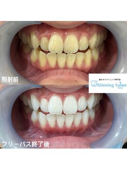ホワイトニングサロン 熊本店/市内のホワイトニング