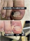 巻き爪と血豆が併発した状態施術