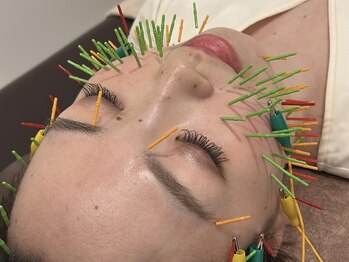 ソラナ(Solana)/美容鍼【100本】百華鍼