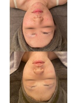 ビジュープラス(Bijou+)/剥離無しハーブピーリング