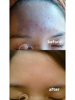 セレネ(SELENE)/おでこニキビ